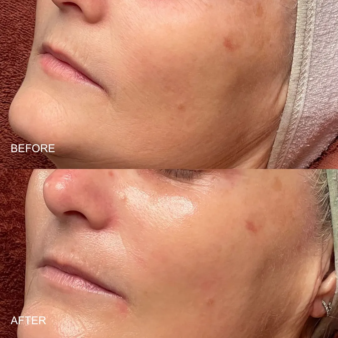 Skin Aura client before and after: visibly clearer, smoother skin